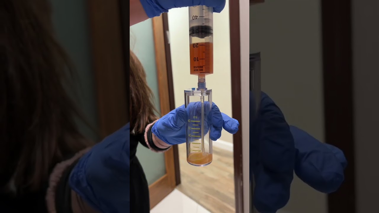 What is a Platelet Rich Plasma (PRP) treatment?