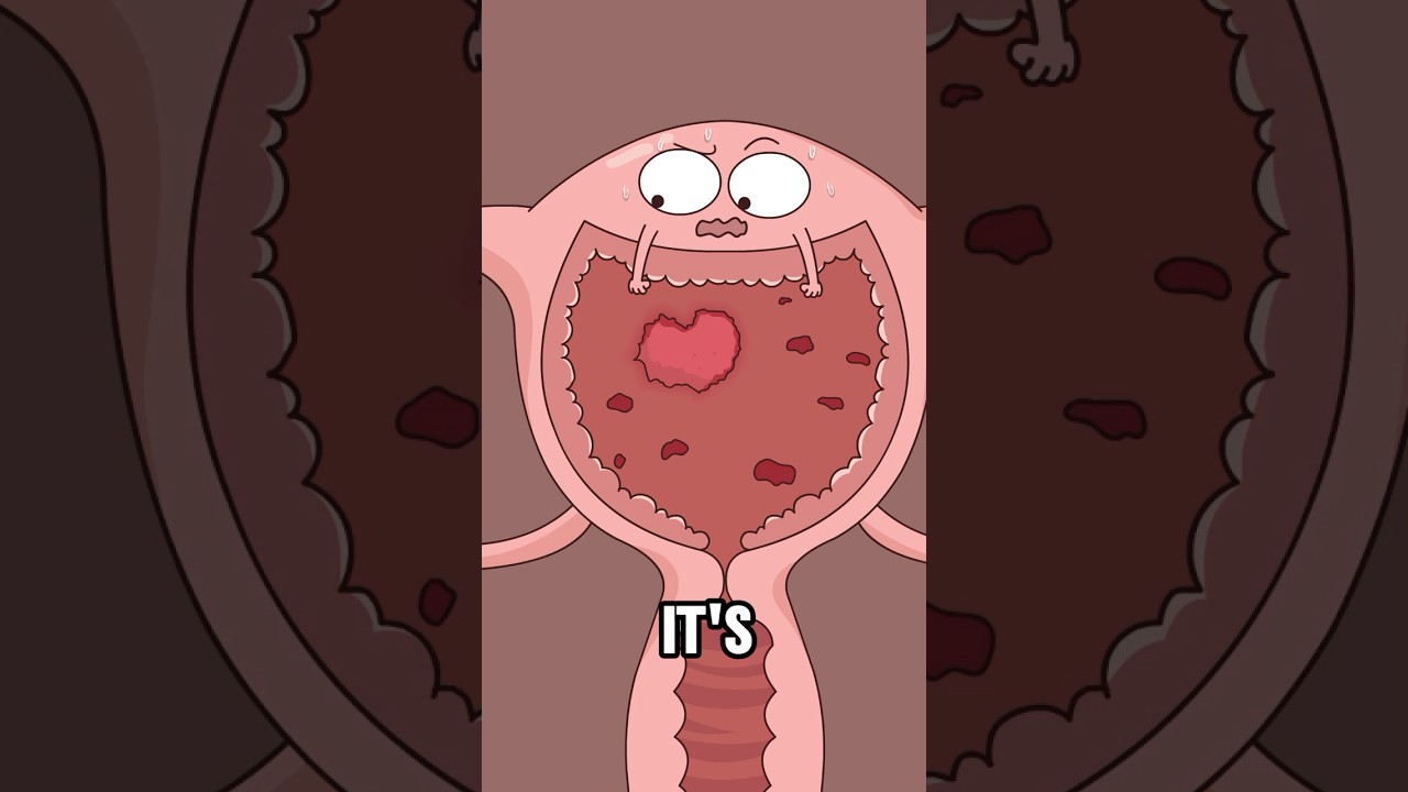 What causes endometriosis?#animation #funny #shorts #health #trending