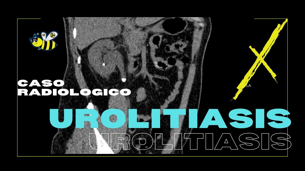 Urolitiasis (aprendiendo anatomía, radiología y patología abdominal)