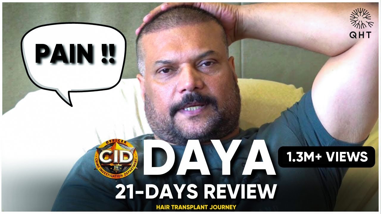 FUE Hair Transplant Results | DAYA's FUE Hair Transplant Results - Actor's Honest Experience | Hair