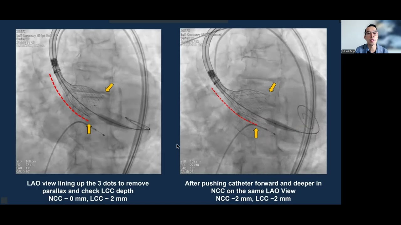 China Structural Week 2025 Lecture: Innovations to Democratize Structural Heart Therapies