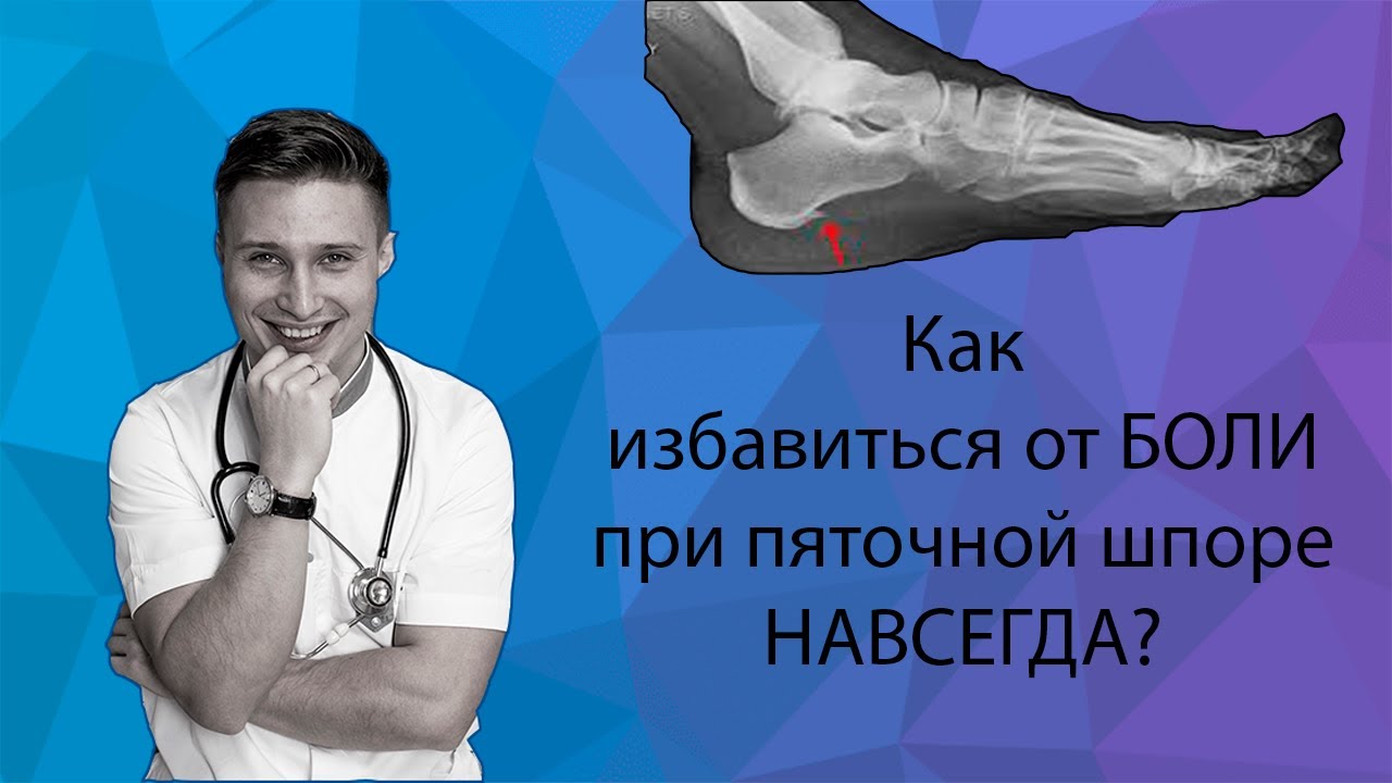 Как избавиться НАВСЕГДА от БОЛИ при ПЯТОЧНОЙ ШПОРЕ: народное средство