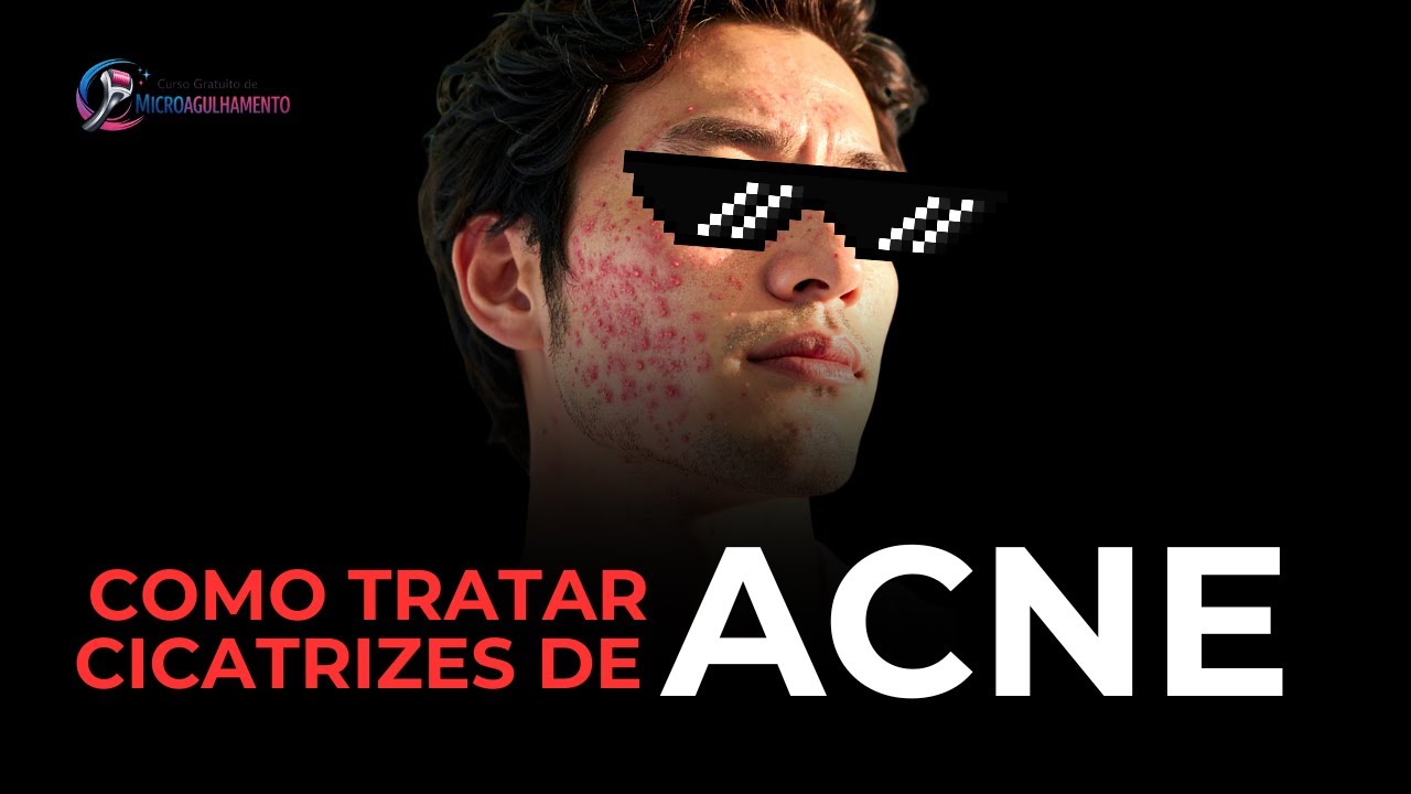 Não cometa esse erro para tratar cicatriz de acne
