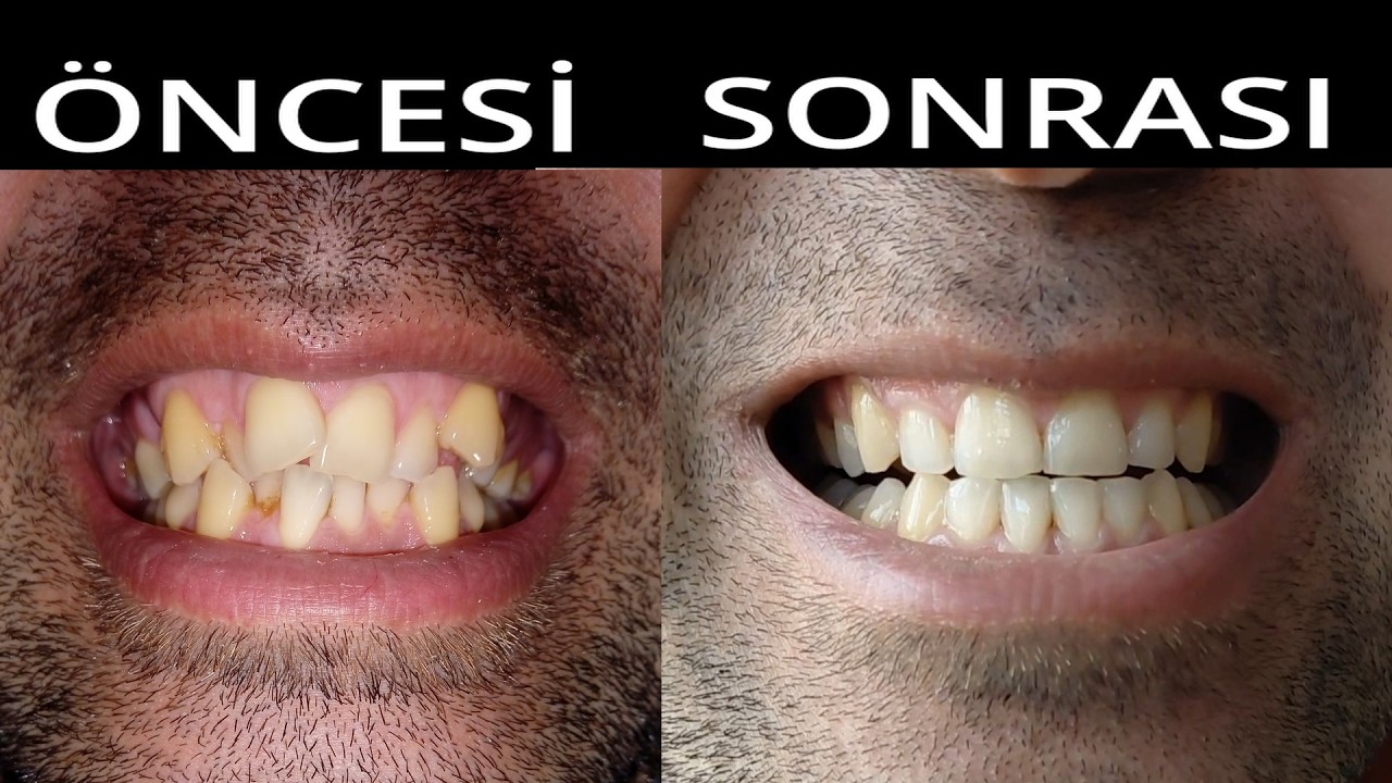Diş Teli Tedavisi Süreci