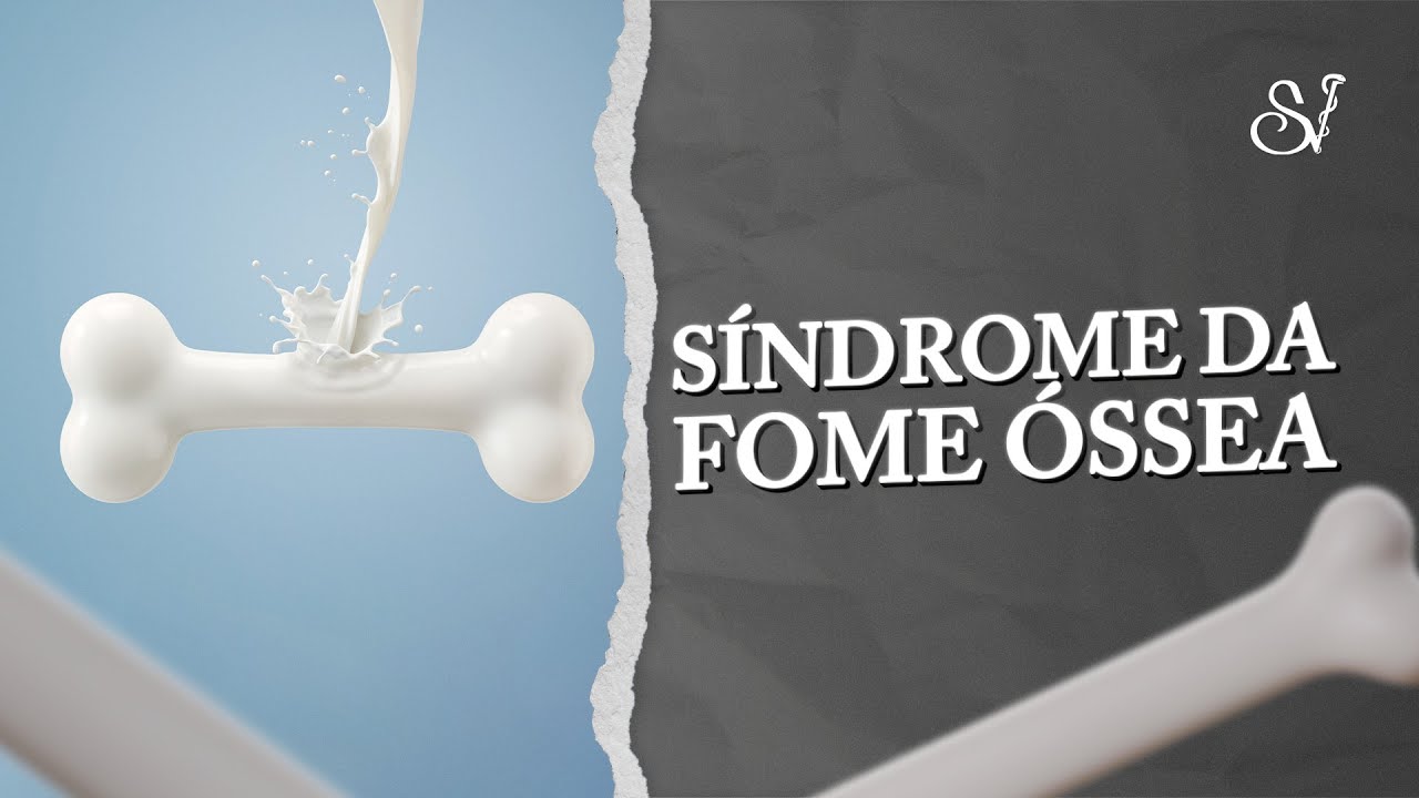 Síndrome da fome óssea - hipocalcemia após cirurgia de paratireoides