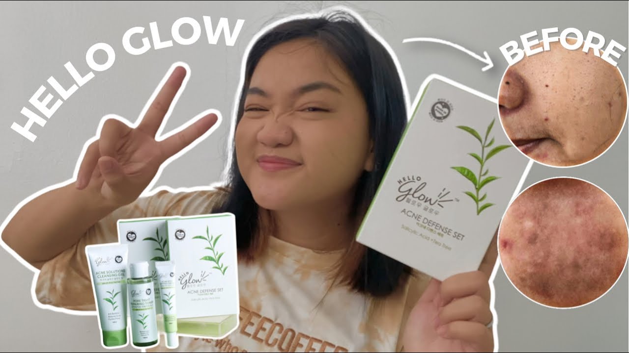 1 WEEK REVIEW OF HELLO GLOW ACNE DEFENSE SET (Ingredients, experience and how I use it)