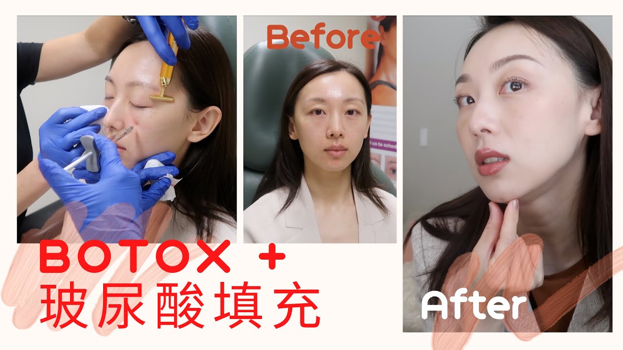 【Anna阿姨 医美vlog#4】肉毒素Botox 玻尿酸乔雅登Filler | 年近四十，终究逃不过这一针