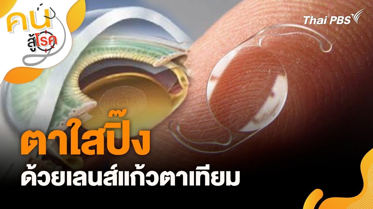 ตาใสปิ๊ง ด้วยเลนส์แก้วตาเทียม | คนสู้โรค