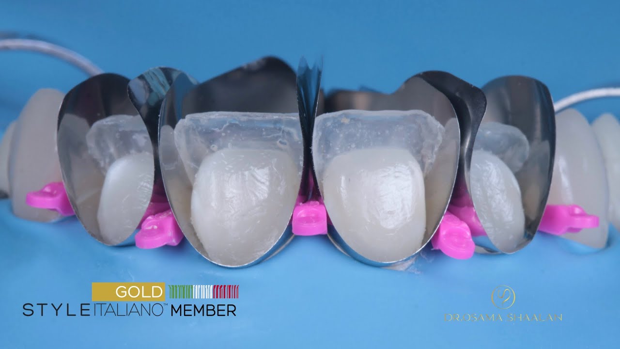 Composite resin bonding - Direct veneering with simplified layering technique
