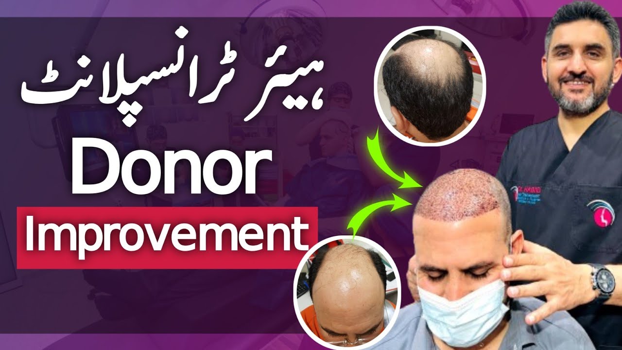 Hair Transplant Donor Improvements | Expert Tips by Dr. Habib