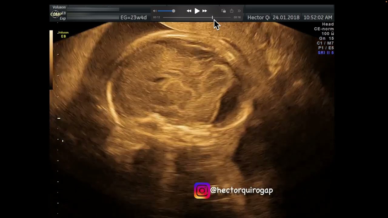 Solución al caso de Neurosonografía fetal publicado el 11 de Mayo del 2023