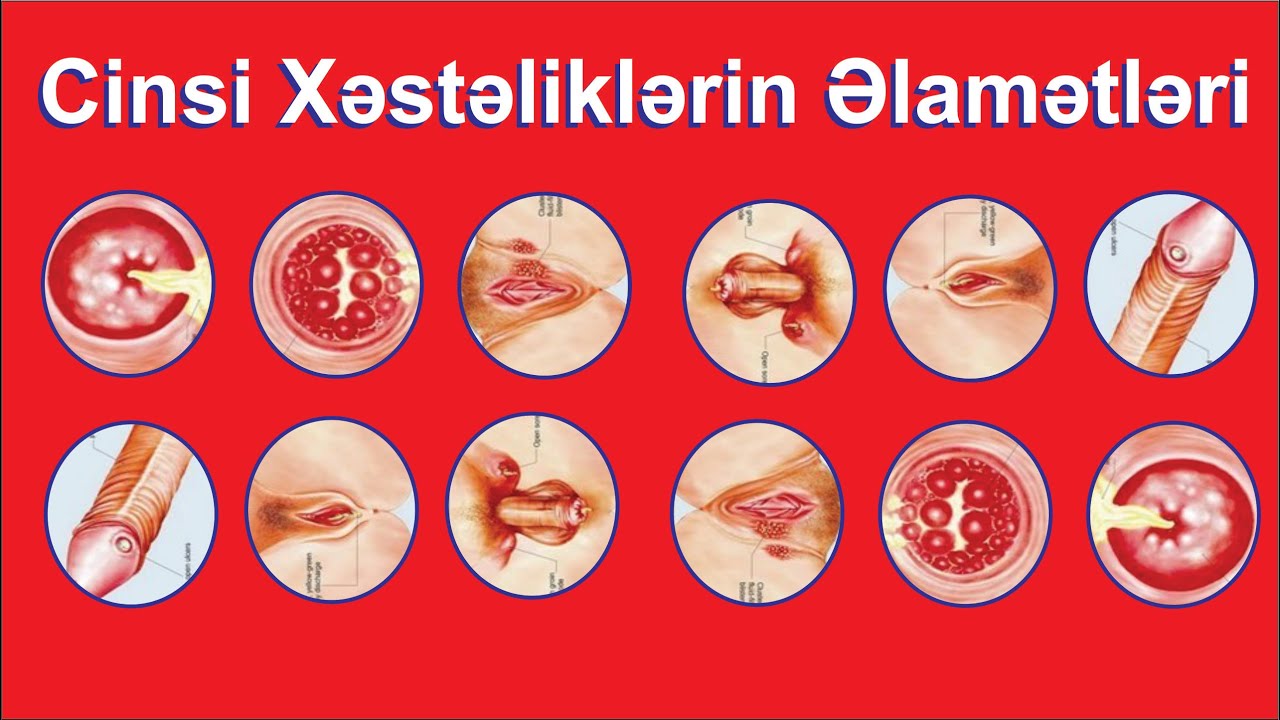 İnfeksiya əlamətləri_Dr. Həsən 055_3480088