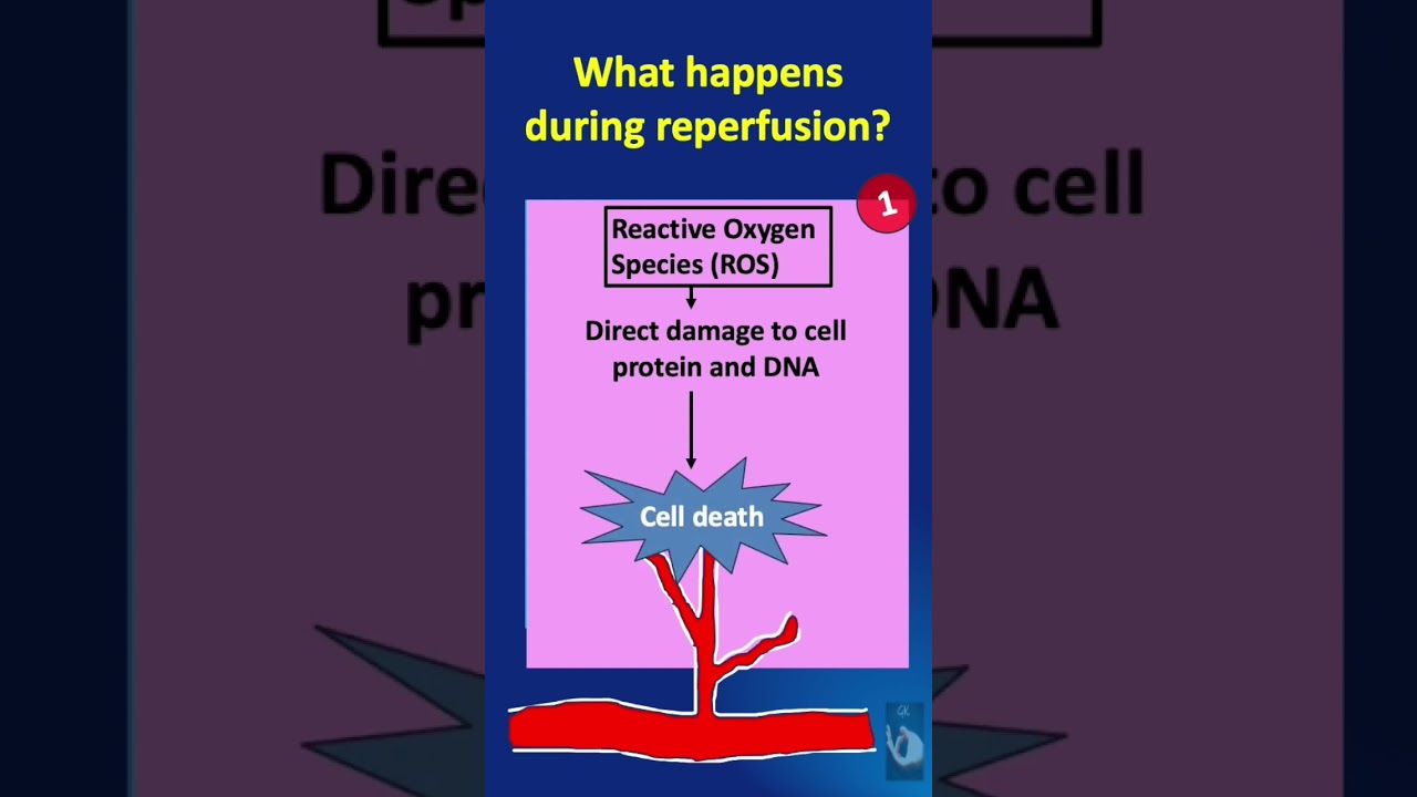 Shorts # 119: Ischemia-Reperfusion Injury (IRI) - What happens during the reperfusion phase?