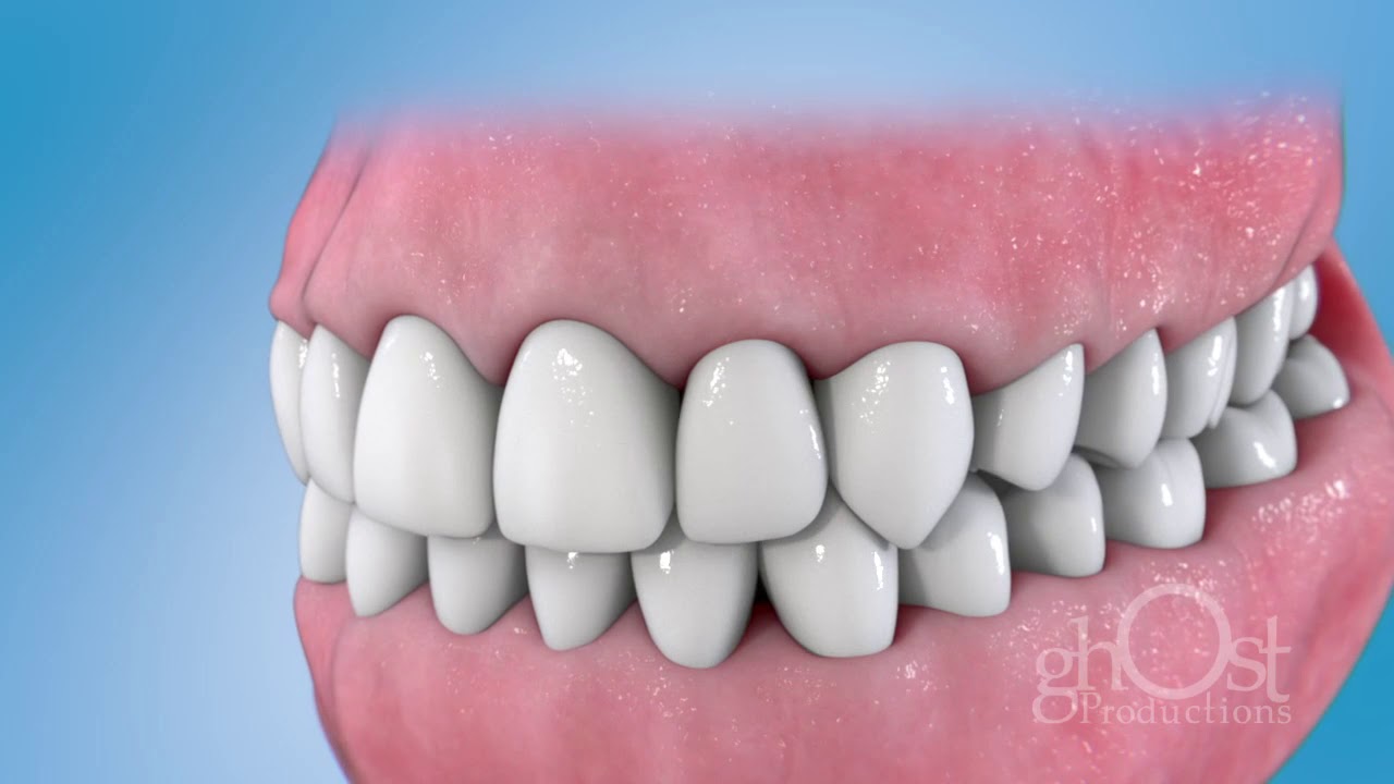 Patterson Dental: Understanding Crown Lengthening Technique - 3D Dental Animation by Ghost Medical