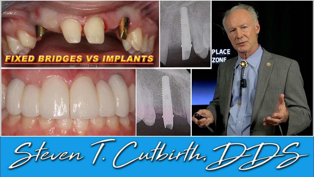Fixed Bridges vs Implants to Replace Missing Teeth - Dental Minute with Steven T. Cutbirth, DDS