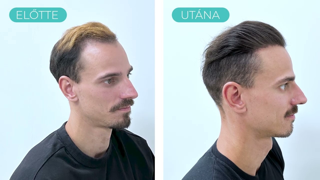 HAJBEÜLTETÉS 28 ÉVESEN_TURBOHAIR MEDICAL_4000 hajszál beültetése