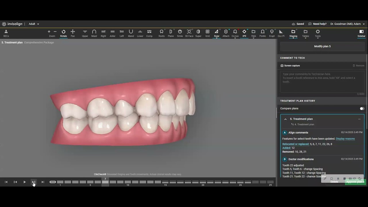 Reversing a 4 Premolar Extraction Case with Reopening of the Extraction Site using Aligners/ Braces