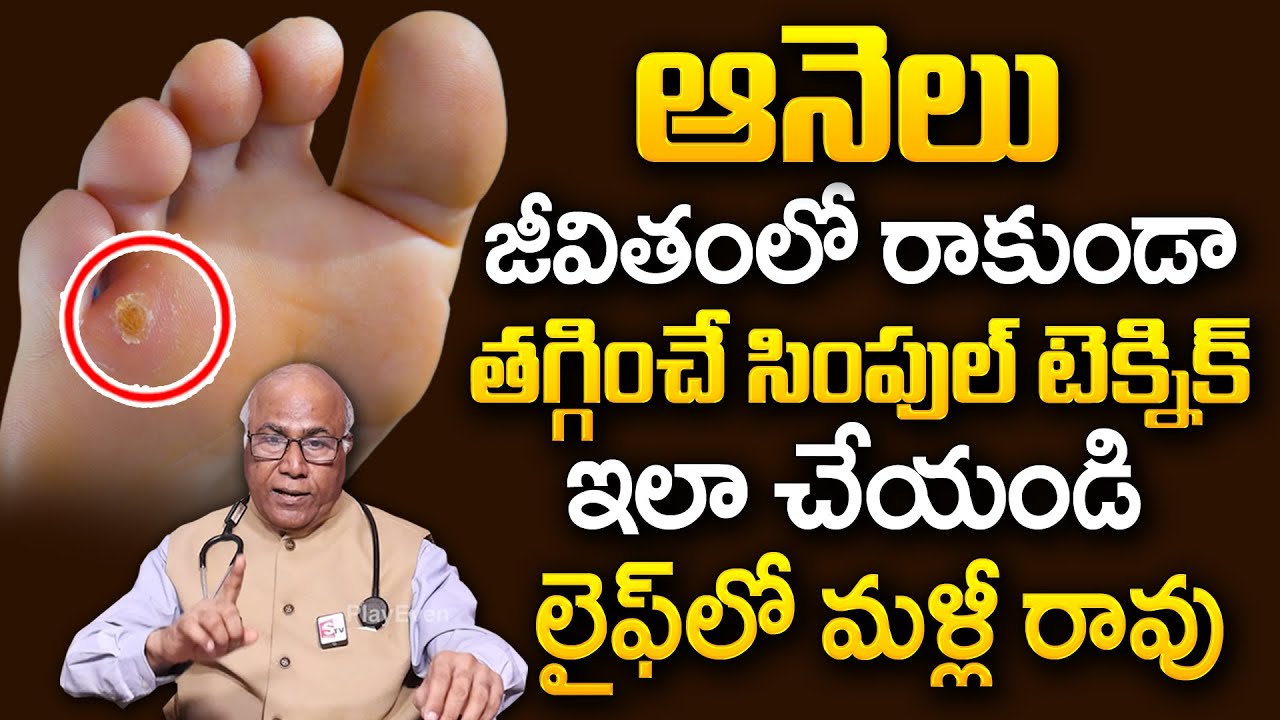 ఇలా చేస్తే ఆనెలు దెబ్బకి మటుమాయం | Corns | How to Removal Foot Corn? | Dr CL Venkat Rao | PlayEven