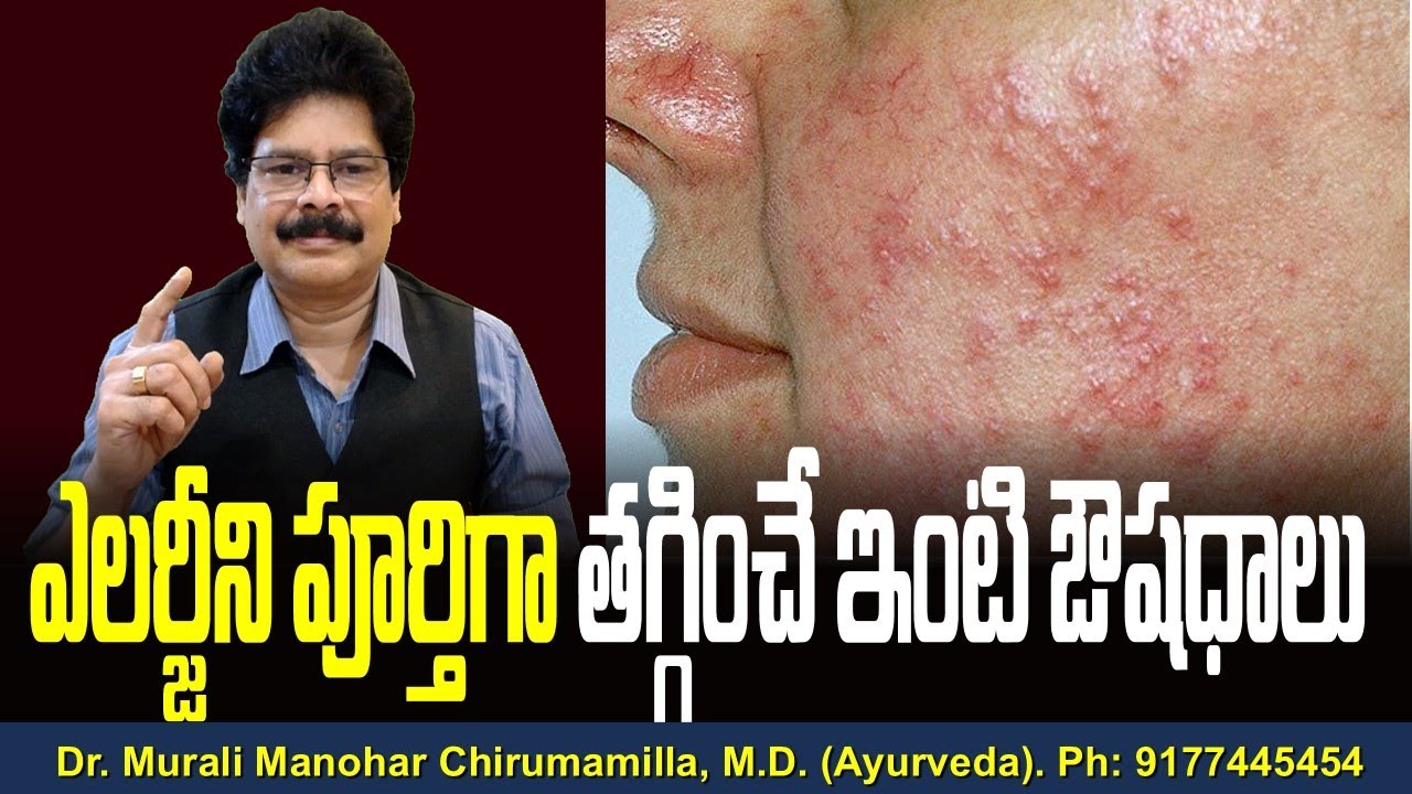 ఎలర్జీని పూర్తిగా తగ్గించే ఇంటి ఔషధాలు | Home remedy for Allergy in telugu. #facts