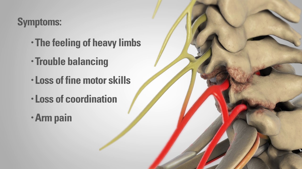 Cervical Laminectomy - Patient Education
