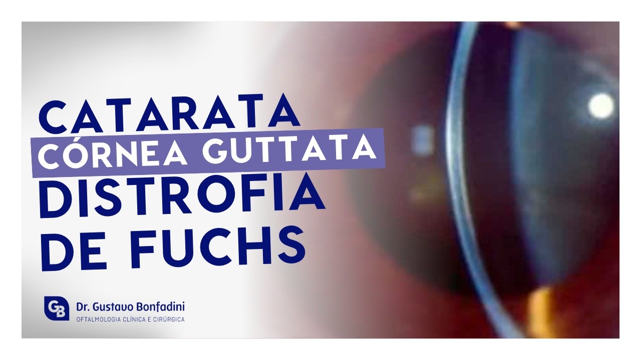 CATARATA E DISTROFIA DE FUCHS: COMO RECUPERAR A VISÃO 5X MAIS RÁPIDO