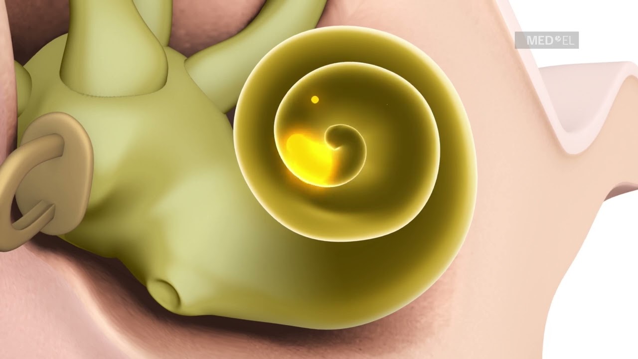 SYNCHRONY Cochlea-Implantat von MED-EL – Wie funktioniert ein Cochlea-Implantat?