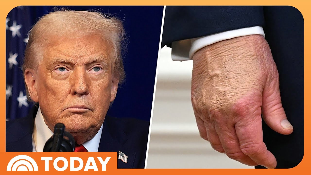 Trump Defends His Health After Viral Images of His Bruised Hand