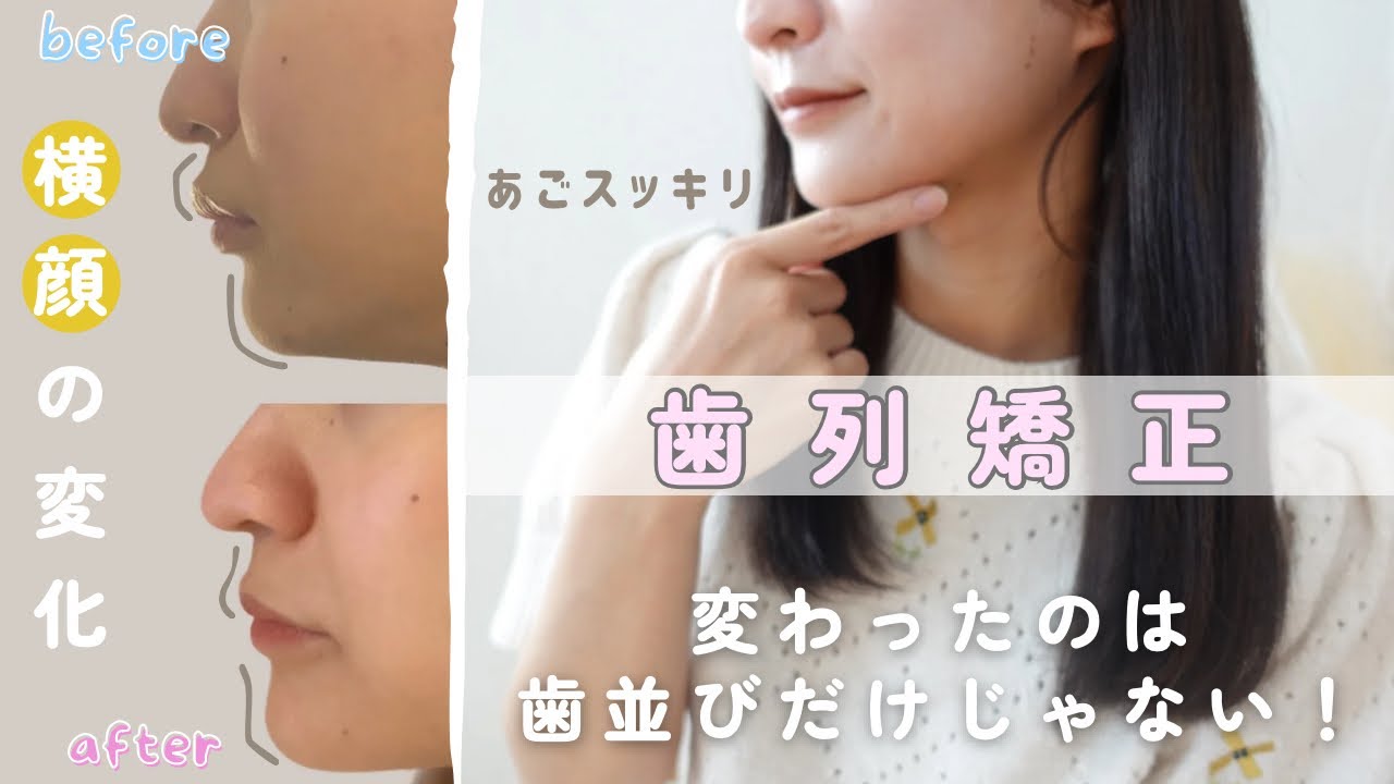 【歯列矯正】3年間の横顔の変化まとめてみた！｜顎スッキリ｜顔つき変わったかな？🥹