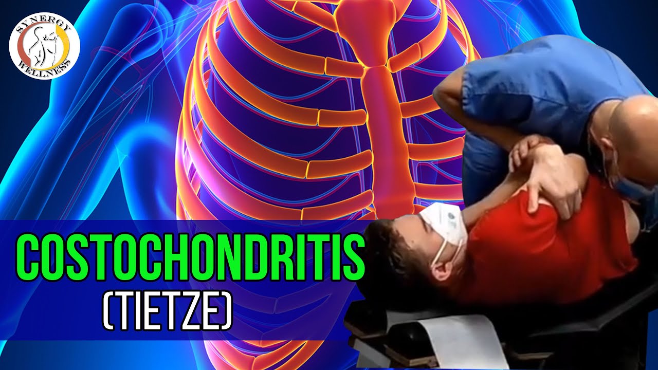 Costochondritis (Tietze) Chiropractic Evaluation & Treatment | Synergy Wellness Chiropractic NYC