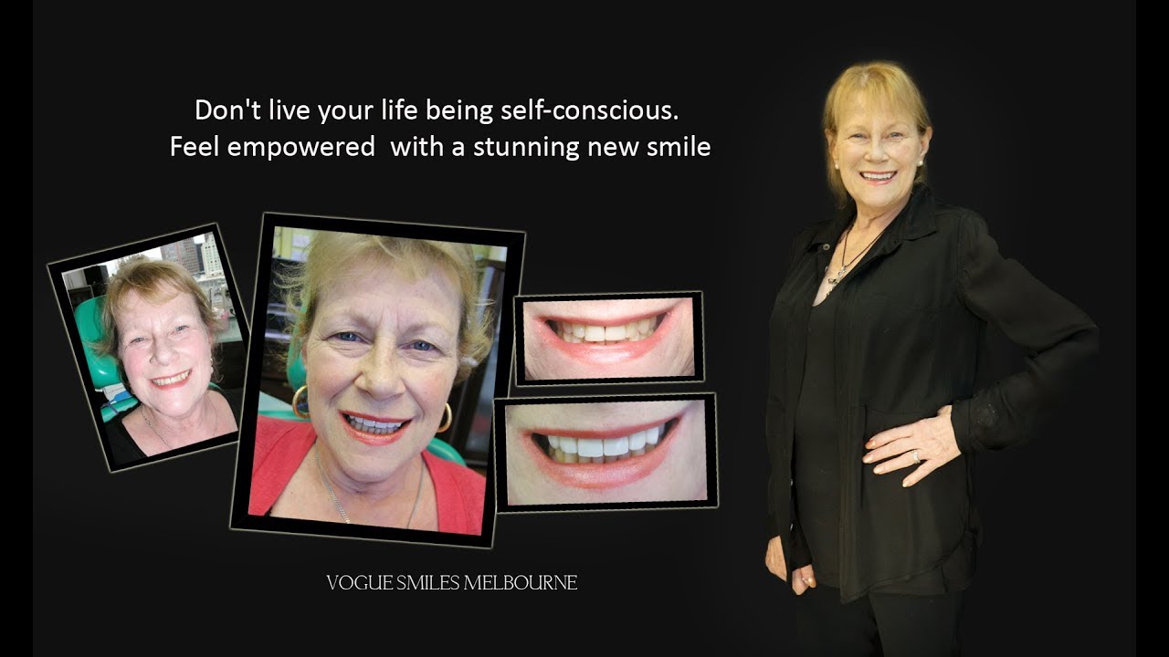 Same-Day #Smile #Rejuvenation with #DENTAL BONDING Melbourne  | VOGUE SMILES MELBOURNE