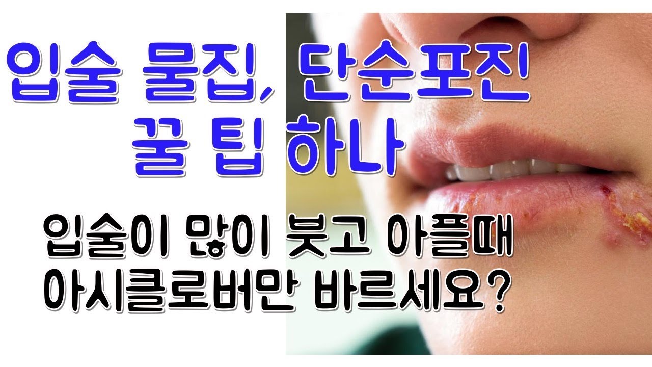 입술 물집 (단순포진) 치료 꿀팁 하나 알려 드립니다! (아시클로버 vs 티로서겔)