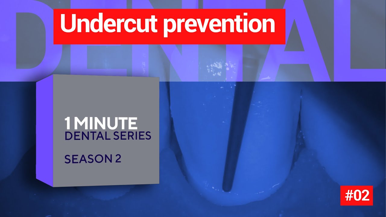 Undercut prevention. 1 dental minute