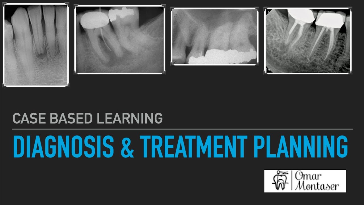 Case Based Learning: Diagnosis and Treatment Planning in Endodontics