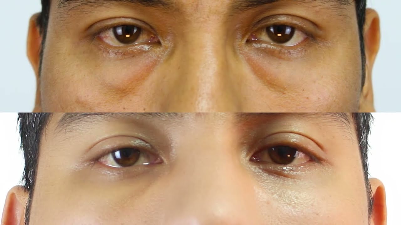 Mirada cansada 👁️ Blefaroplastia inferior 👀 PROMINENTES BOLSAS en los OJOS 👀 Dr Percy Nevado Cirugía