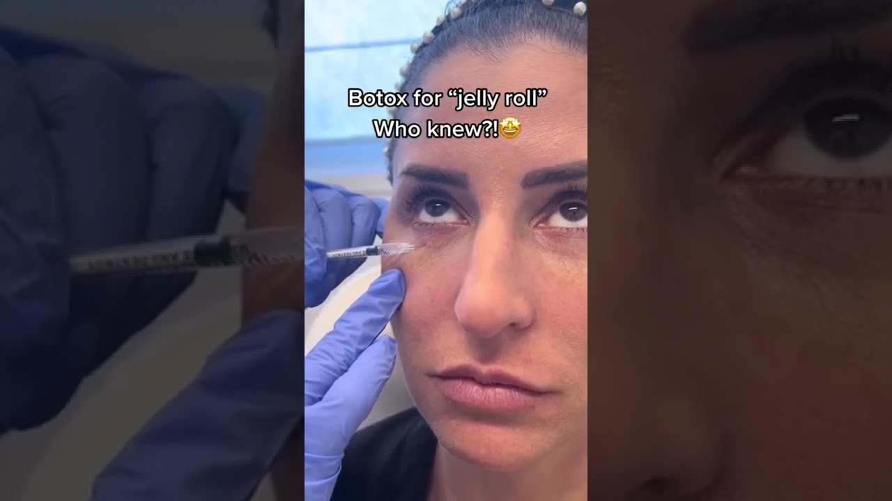 #Botox for under-eye crease #botoxtreatment #jellyroll