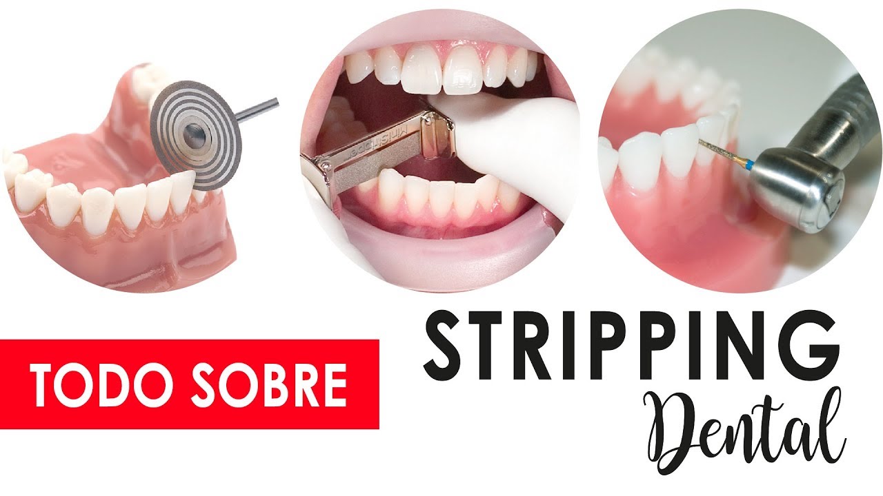 TALLADO DENTAL INTERPROXIMAL | ¿REMPLAZA EXTRACCIONES? 😀