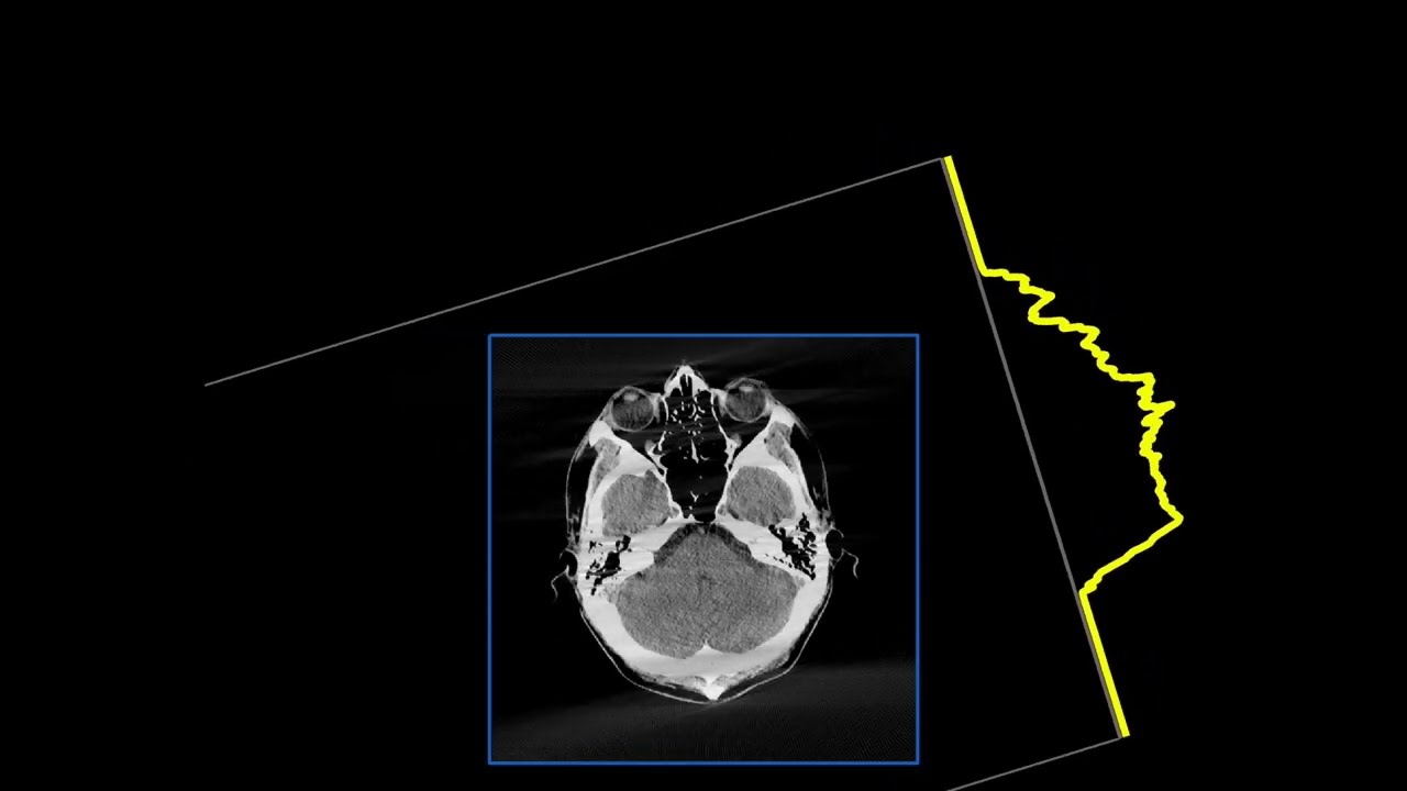 Filtered back-projection reconstruction of a head slice