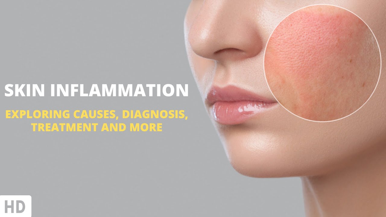 Empowering Your Skin: Navigating the Challenges of Inflammation