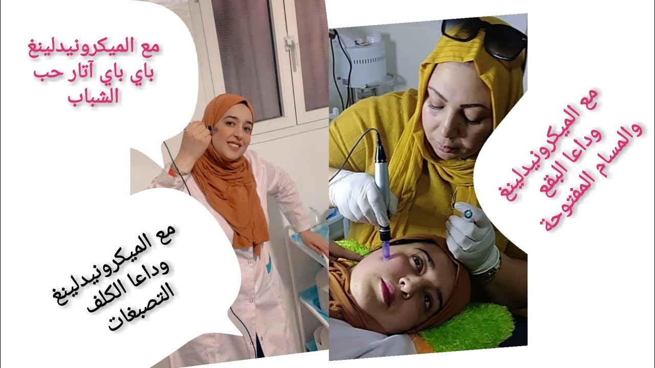 الميكرونيدلينغ أحسن تقنية لتصفية البشرة و لمعانها 💯و التخلص من جميع مشاكلها 👍