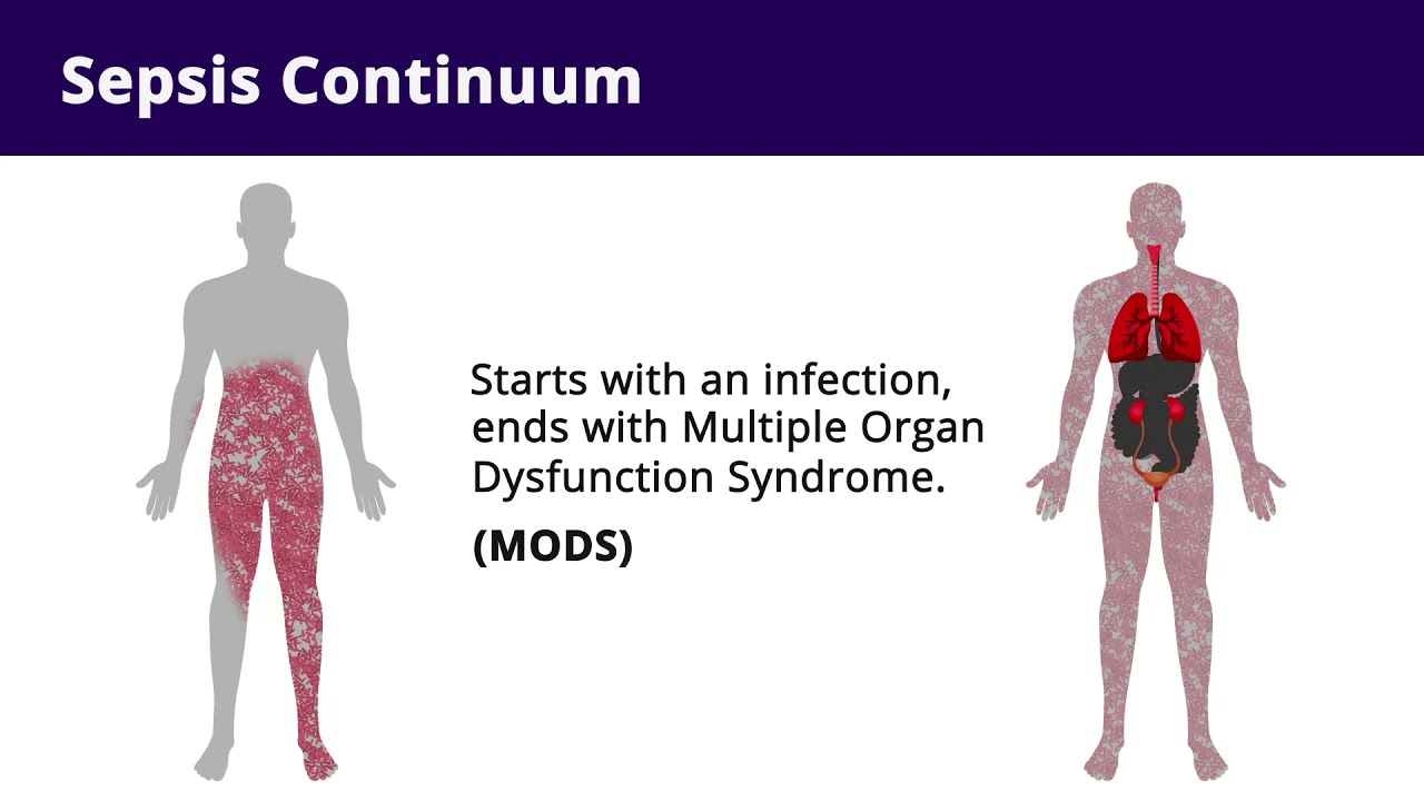 Septic Shock (Sepsis) | Pathophysiology and Nursing Interventions