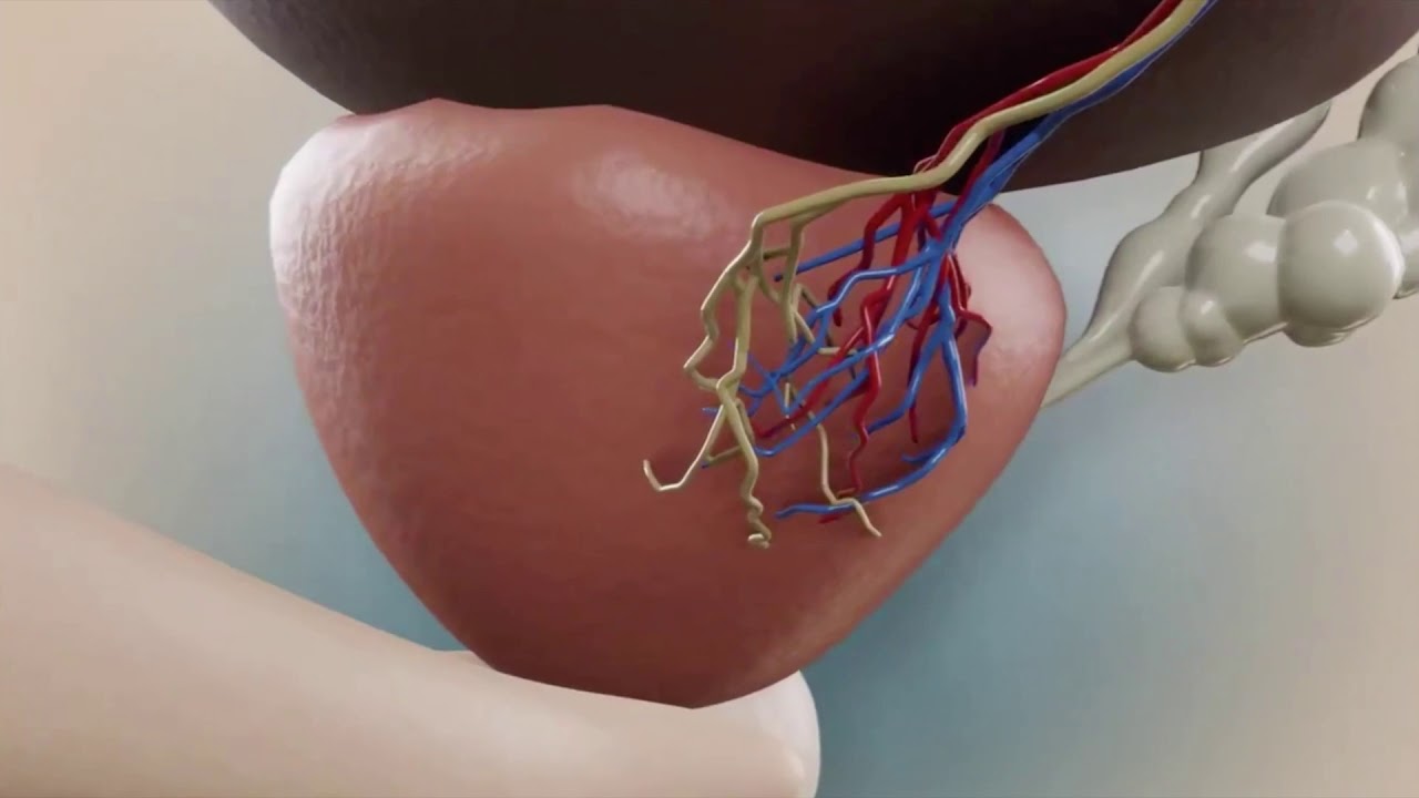 Chirurgie assistée par Robot pour cancer de prostate