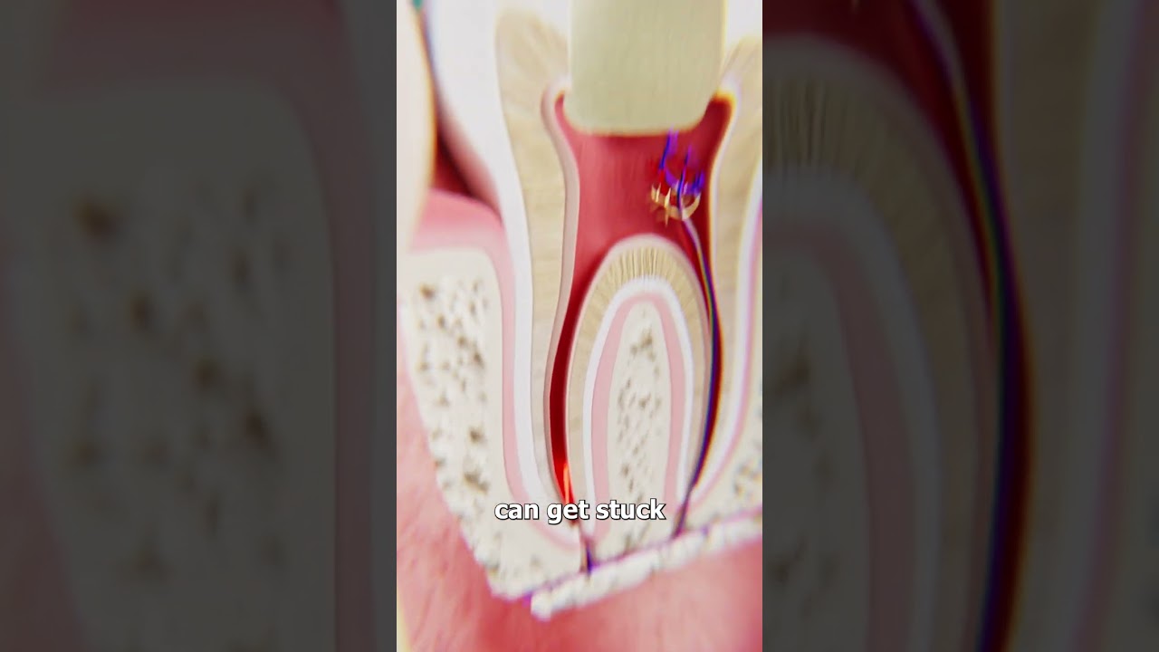 When Root Canal Tools Break Off 😨
