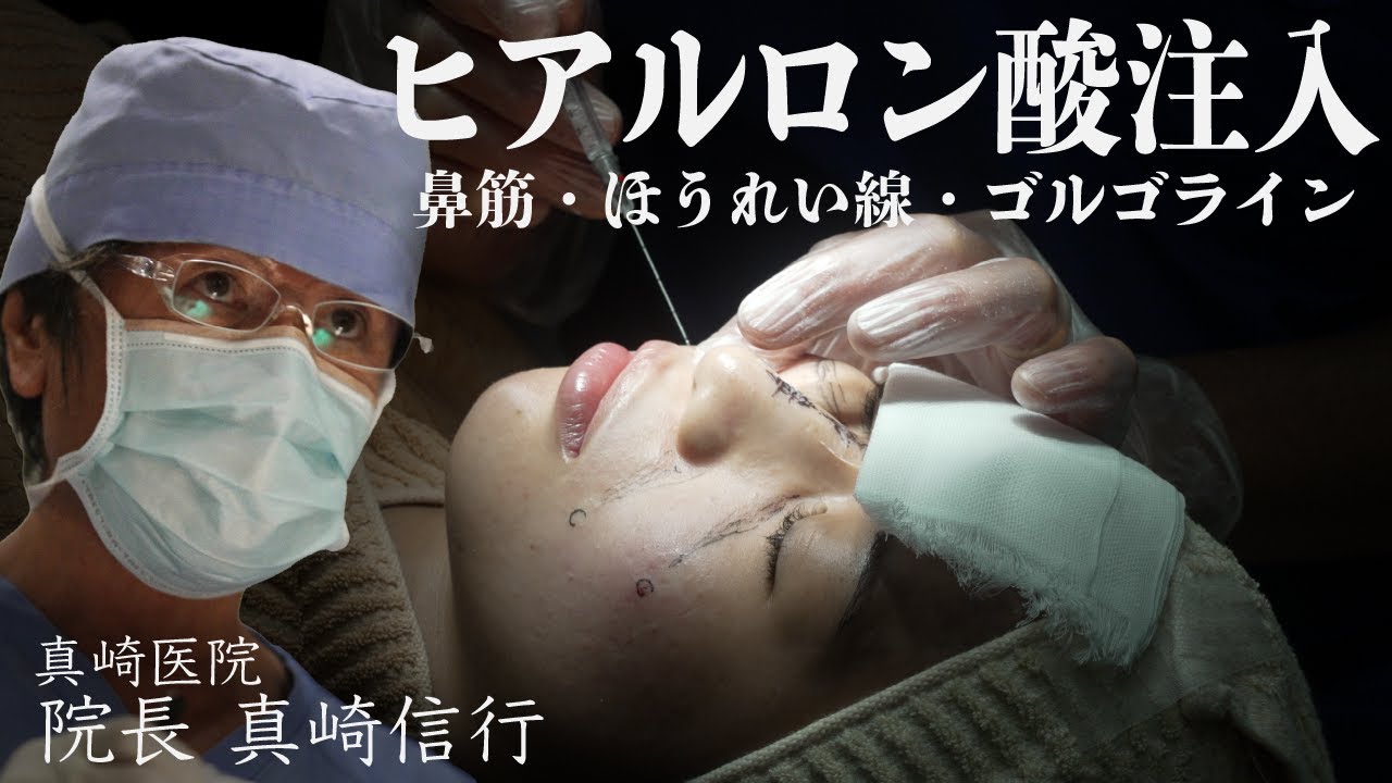 【ヒアルロン酸注入（注射）について徹底解説！】鼻筋・ほうれい線・ゴルゴラインのくぼみ・シワを膨らます事により改善します【真崎医院】