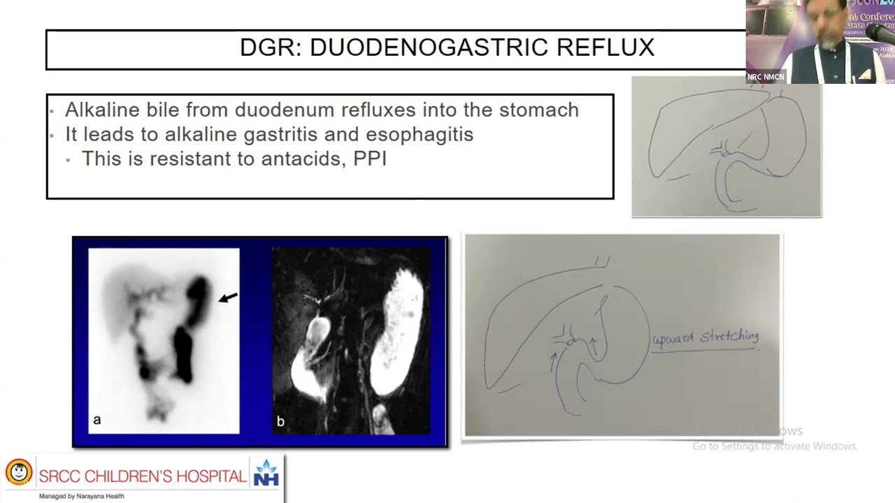 Why roux en y Hepaticojejunostomy is better than hepaticodudenostomy, Dr Rasik Shah