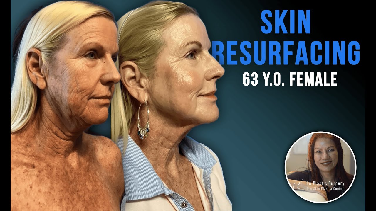 Facelift Alternative: Plasma Resurfacing | Scarless Facial Rejuvenation by Dr. Lacerna