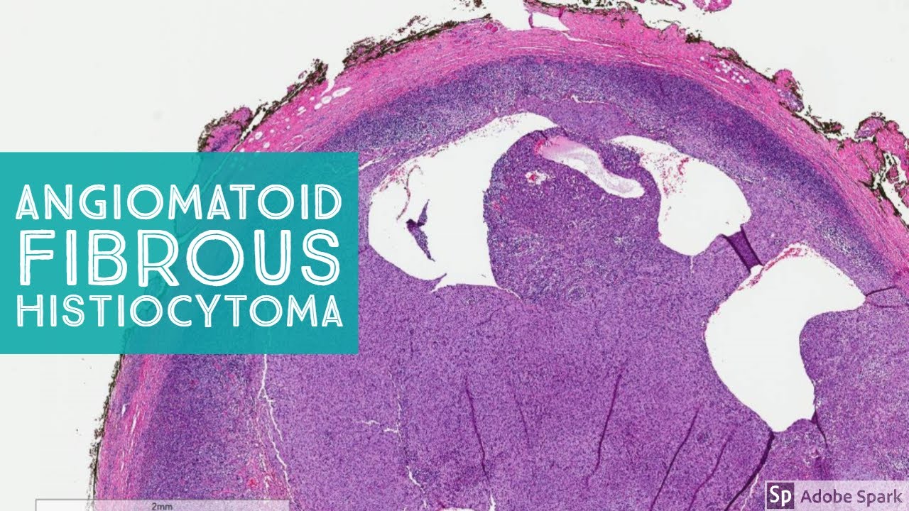 Angiomatoid Fibrous Histiocytoma 101 (Note: it's NOT aneurysmal dermatofibroma!)