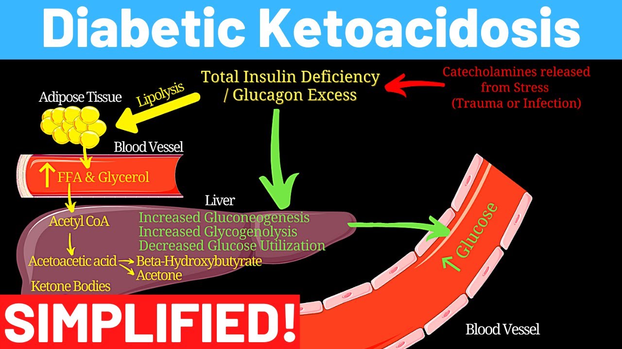 What is Diabetic Ketoacidosis? - Complications of Diabetes | Panmedicad