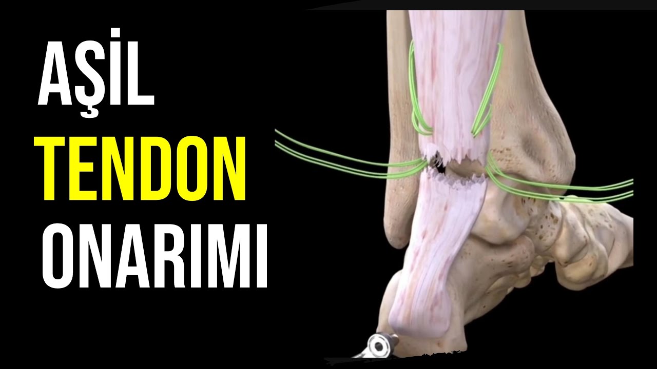 Aşil Tendon Onarımı ! Achilles Tendon Repair