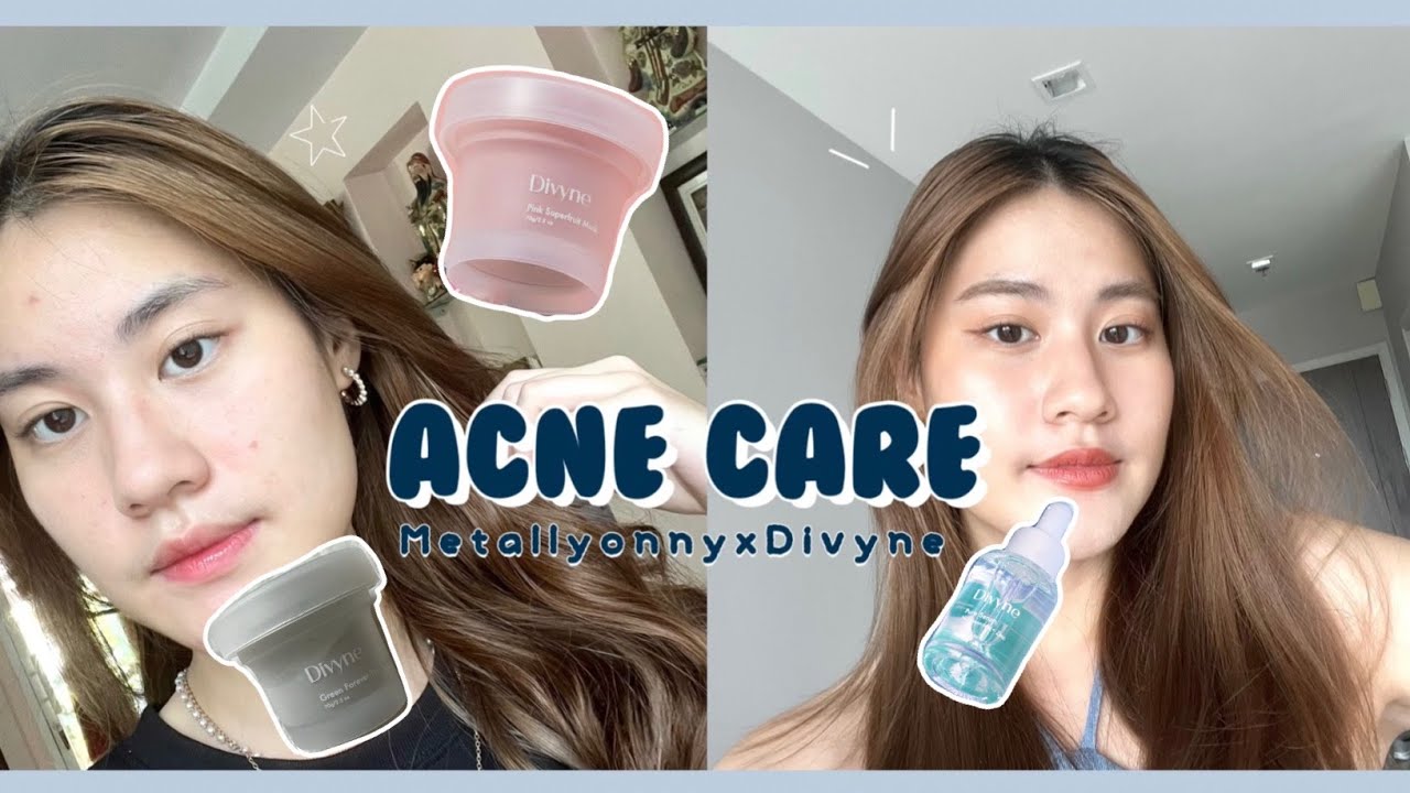 แชร์ประสบการณ์รักษาสิวกับมาส์กและเซรั่มจาก Divyne