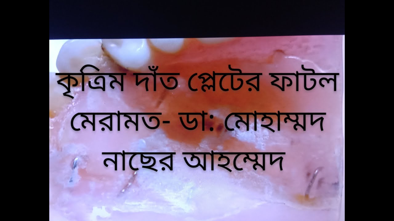 CRACK OF COMPLETE DENTURE PLATE REPAIR- DR.  MOHAMMAD NASER AHAMMED.